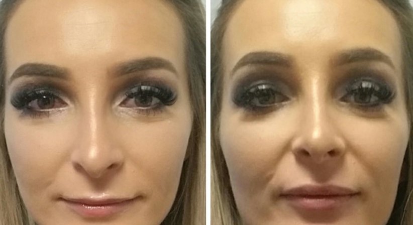 Hyaluronsäure (Filler) - Dr. med. univ. Mag. art. Hanna Sheu, MPH - Allgemeinchirurgin Linz 4020