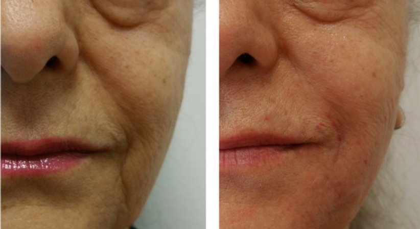 Hyaluronsäure (Filler) - Dr. med. univ. Mag. art. Hanna Sheu, MPH - Allgemeinchirurgin Linz 4020