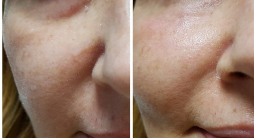 Hyaluronsäure (Filler) - Dr. med. univ. Mag. art. Hanna Sheu, MPH - Allgemeinchirurgin Linz 4020