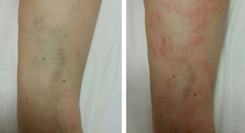 Krampfadern (Schaumverödung) - Dr. med. univ. Mag. art. Hanna Sheu, MPH - Allgemeinchirurgin Linz 4020