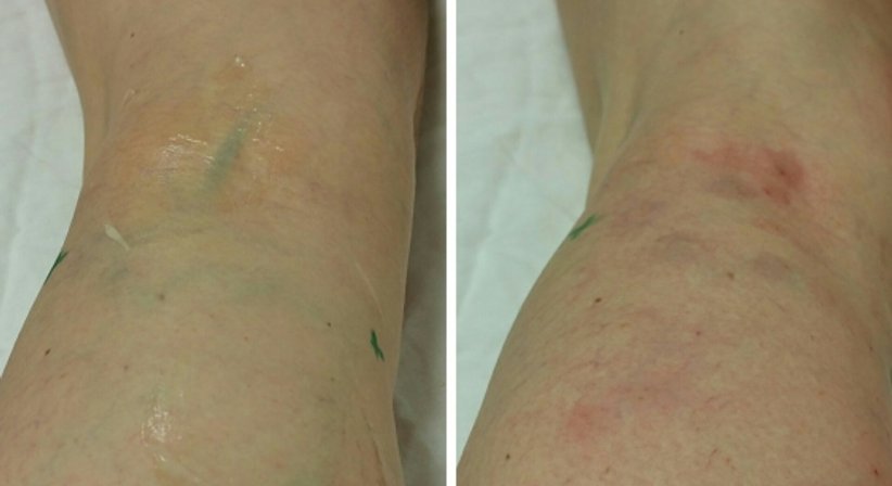 Krampfadern (Schaumverödung) - Dr. med. univ. Mag. art. Hanna Sheu, MPH - Allgemeinchirurgin Linz 4020