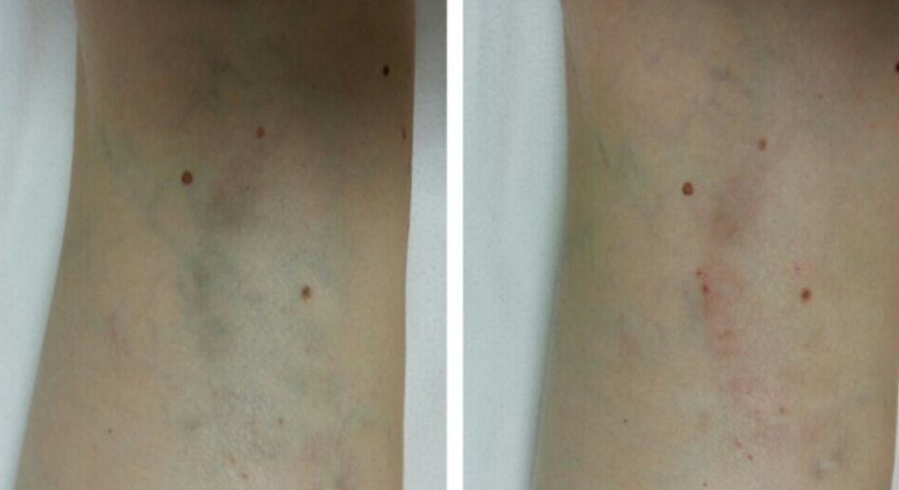 Krampfadern (Schaumverödung) - Dr. med. univ. Mag. art. Hanna Sheu, MPH - Allgemeinchirurgin Linz 4020