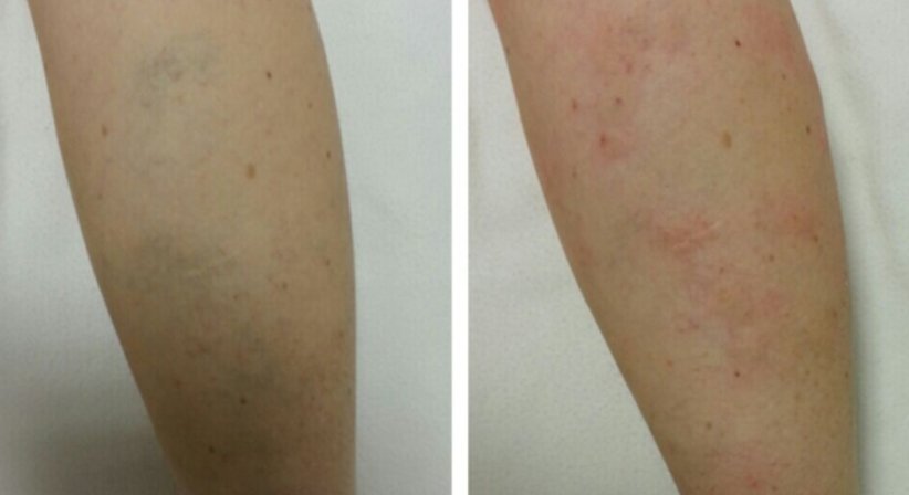 Krampfadern (Schaumverödung) - Dr. med. univ. Mag. art. Hanna Sheu, MPH - Allgemeinchirurgin Linz 4020