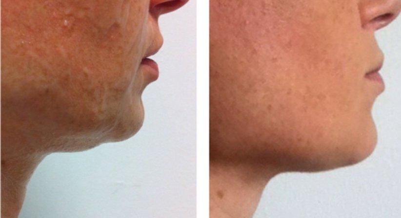 PDO Fadenlifting (auflösende Fäden) - Dr. med. univ. Mag. art. Hanna Sheu, MPH - Allgemeinchirurgin Linz 4020