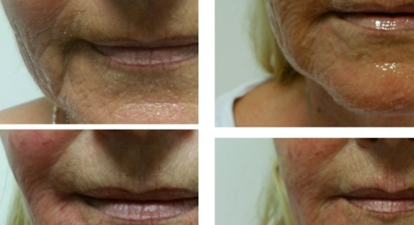 PDO Fadenlifting (auflösende Fäden) - Dr. med. univ. Mag. art. Hanna Sheu, MPH - Allgemeinchirurgin Linz 4020