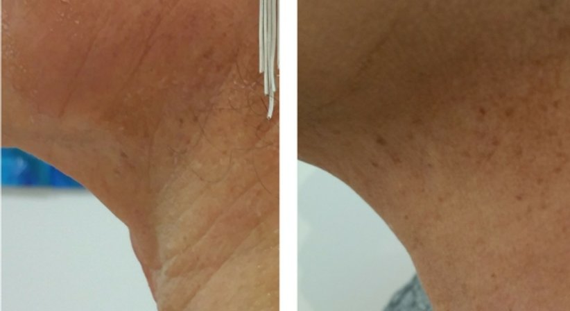 PDO Fadenlifting (auflösende Fäden) - Dr. med. univ. Mag. art. Hanna Sheu, MPH - Allgemeinchirurgin Linz 4020