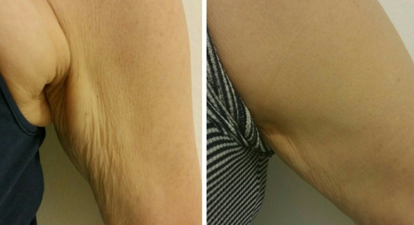 PDO Fadenlifting (auflösende Fäden) - Dr. med. univ. Mag. art. Hanna Sheu, MPH - Allgemeinchirurgin Linz 4020