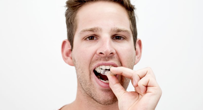 Unsichtbare Zahnspange - Dr. med. dent. Konstantin Pischel, Msc. - Zahnarzt Linz 4020