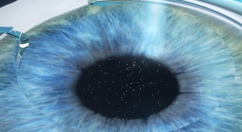 Femto-Lasik - Prim. Univ.-Prof. Dr. Siegfried G. Priglinger - Augenarzt Linz 4020