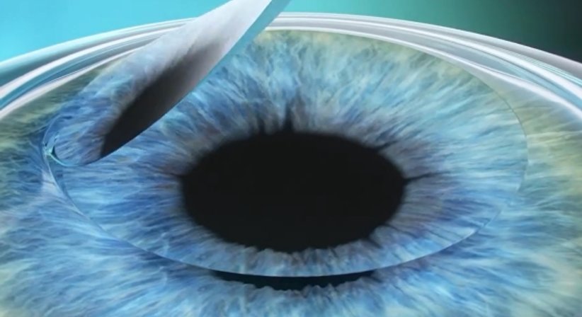 Femto-Lasik - Prim. Univ.-Prof. Dr. Siegfried G. Priglinger - Augenarzt Linz 4020