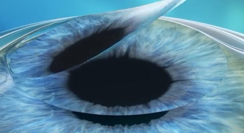 Femto-Lasik - Prim. Univ.-Prof. Dr. Siegfried G. Priglinger - Augenarzt Linz 4020