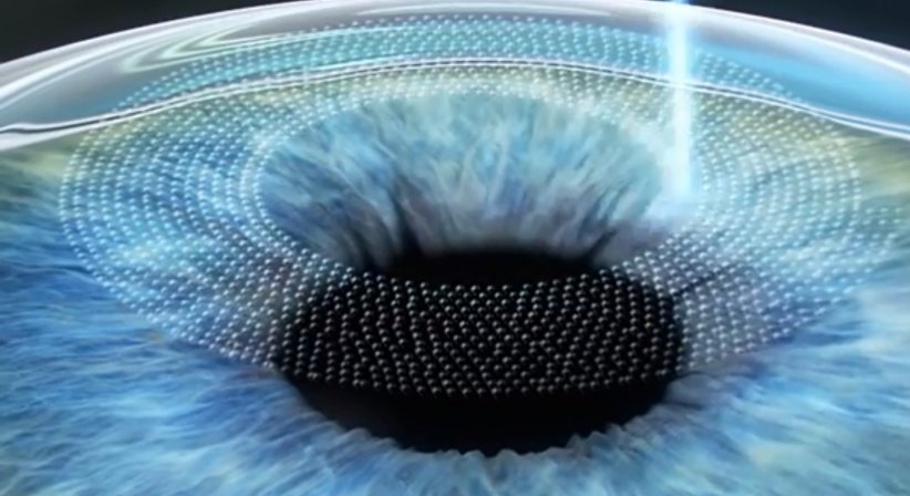 Femto-Lasik - Prim. Univ.-Prof. Dr. Siegfried G. Priglinger - Augenarzt Linz 4020