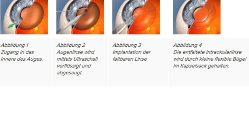 Grauer Star - Prim. Univ.-Prof. Dr. Siegfried G. Priglinger - Augenarzt Linz 4020