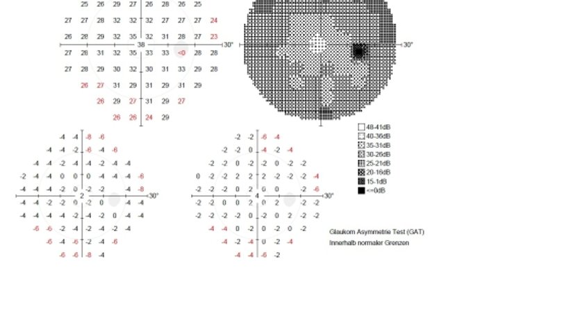 Grüner Star  - Glaukomvorsorge - Prim. Univ.-Prof. Dr. Siegfried G. Priglinger - Augenarzt Linz 4020