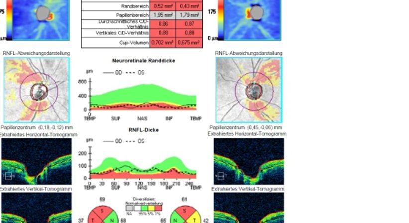 Grüner Star  - Glaukomvorsorge - Prim. Univ.-Prof. Dr. Siegfried G. Priglinger - Augenarzt Linz 4020