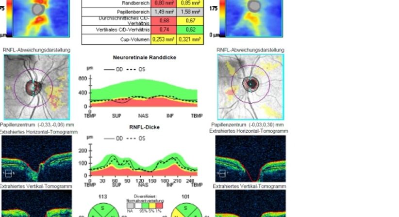 Grüner Star  - Glaukomvorsorge - Prim. Univ.-Prof. Dr. Siegfried G. Priglinger - Augenarzt Linz 4020