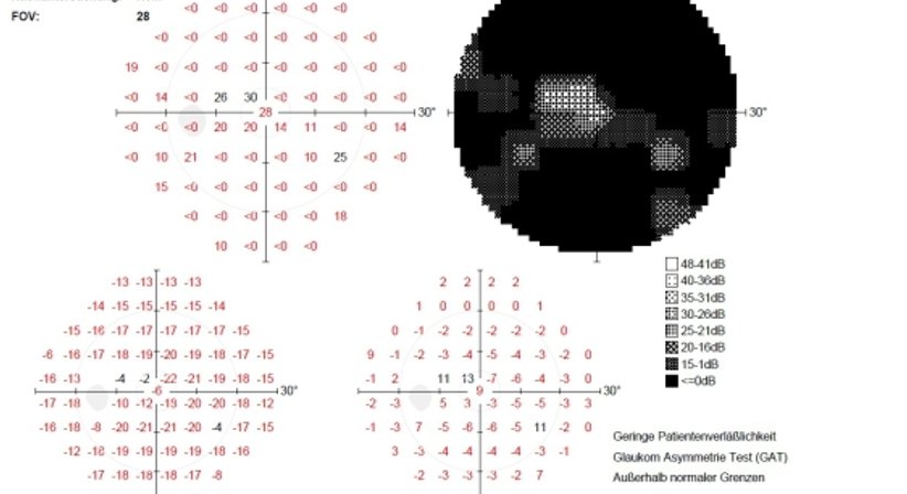 Grüner Star  - Glaukomvorsorge - Prim. Univ.-Prof. Dr. Siegfried G. Priglinger - Augenarzt Linz 4020