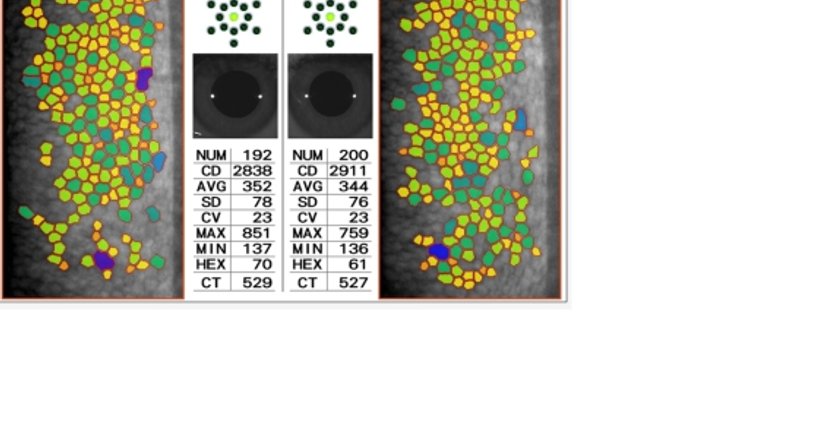 Hornhautuntersuchung - Prim. Univ.-Prof. Dr. Siegfried G. Priglinger - Augenarzt Linz 4020