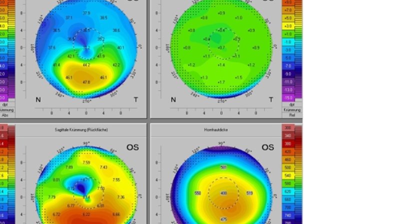 Hornhautuntersuchung - Prim. Univ.-Prof. Dr. Siegfried G. Priglinger - Augenarzt Linz 4020