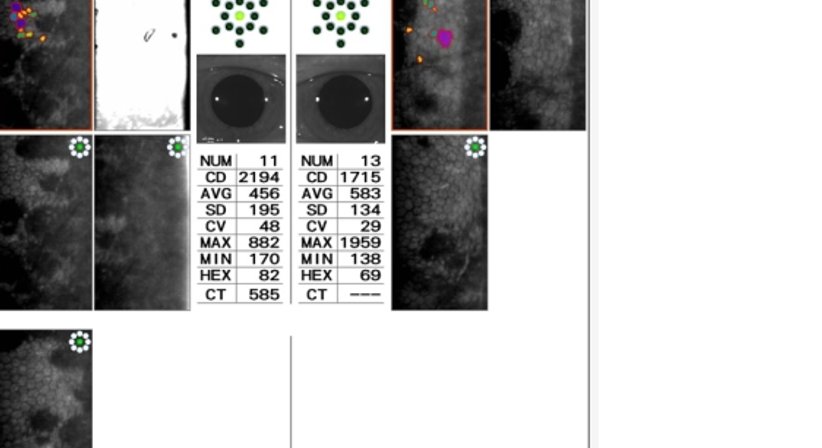 Hornhautuntersuchung - Prim. Univ.-Prof. Dr. Siegfried G. Priglinger - Augenarzt Linz 4020