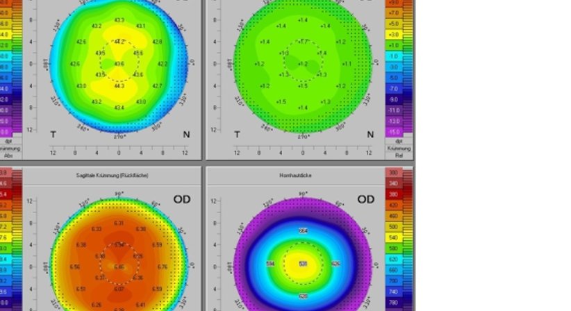Hornhautuntersuchung - Prim. Univ.-Prof. Dr. Siegfried G. Priglinger - Augenarzt Linz 4020