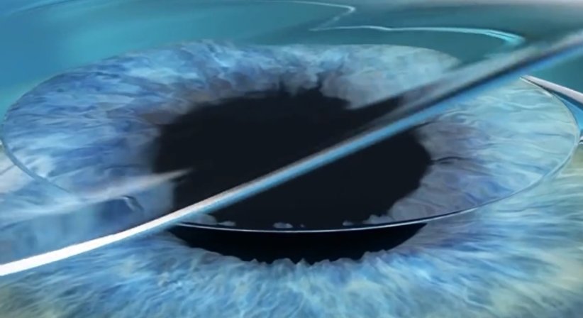 Lasek - Prim. Univ.-Prof. Dr. Siegfried G. Priglinger - Augenarzt Linz 4020