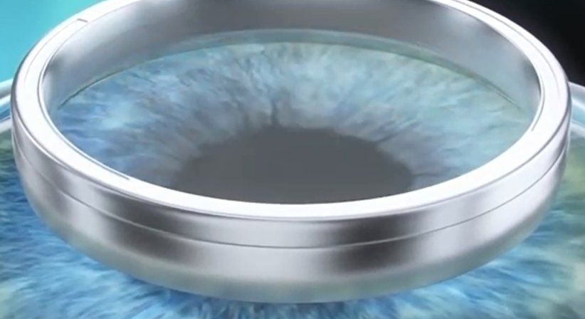 Lasek - Prim. Univ.-Prof. Dr. Siegfried G. Priglinger - Augenarzt Linz 4020