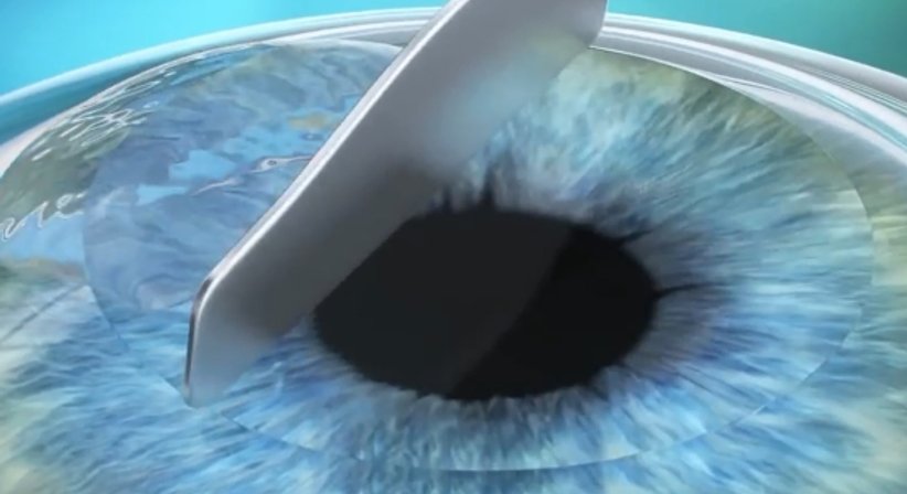 Lasek - Prim. Univ.-Prof. Dr. Siegfried G. Priglinger - Augenarzt Linz 4020