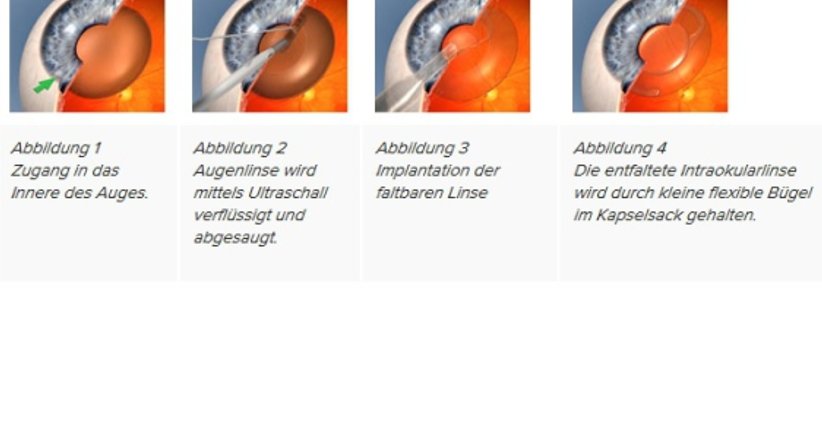 Linsenimplantation - Prim. Univ.-Prof. Dr. Siegfried G. Priglinger - Augenarzt Linz 4020