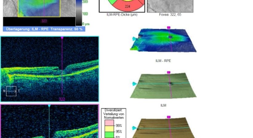 Netzhautuntersuchung - Prim. Univ.-Prof. Dr. Siegfried G. Priglinger - Augenarzt Linz 4020