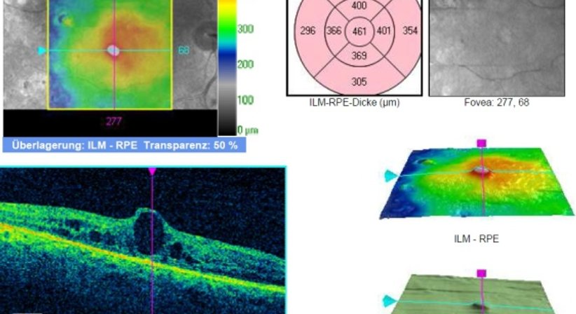 Netzhautuntersuchung - Prim. Univ.-Prof. Dr. Siegfried G. Priglinger - Augenarzt Linz 4020