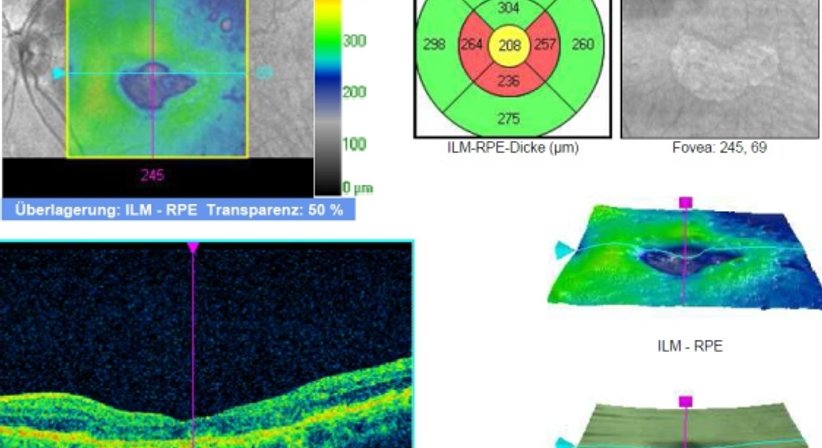 Netzhautuntersuchung - Prim. Univ.-Prof. Dr. Siegfried G. Priglinger - Augenarzt Linz 4020