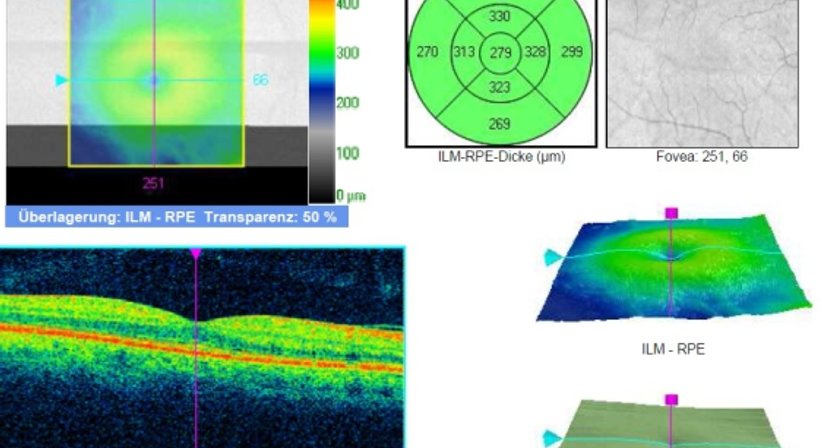 Netzhautuntersuchung - Prim. Univ.-Prof. Dr. Siegfried G. Priglinger - Augenarzt Linz 4020
