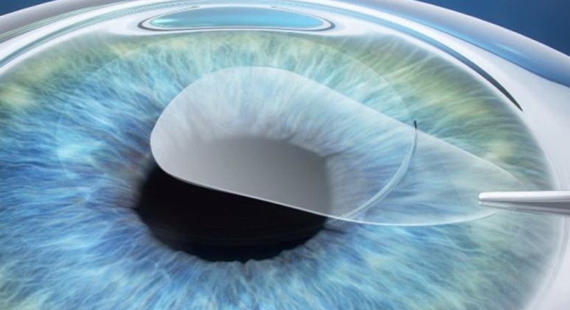 ReLEx-Smile - Prim. Univ.-Prof. Dr. Siegfried G. Priglinger - Augenarzt Linz 4020