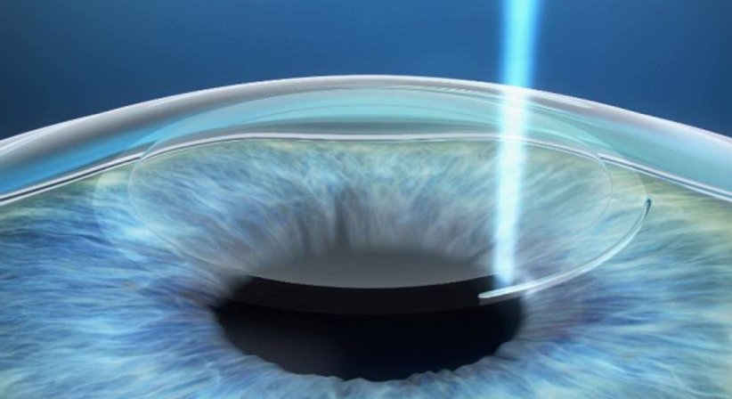 ReLEx-Smile - Prim. Univ.-Prof. Dr. Siegfried G. Priglinger - Augenarzt Linz 4020