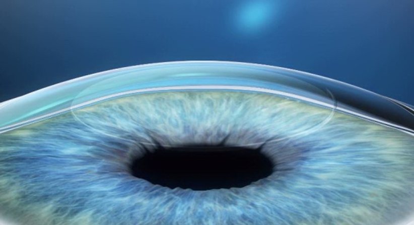 ReLEx-Smile - Prim. Univ.-Prof. Dr. Siegfried G. Priglinger - Augenarzt Linz 4020