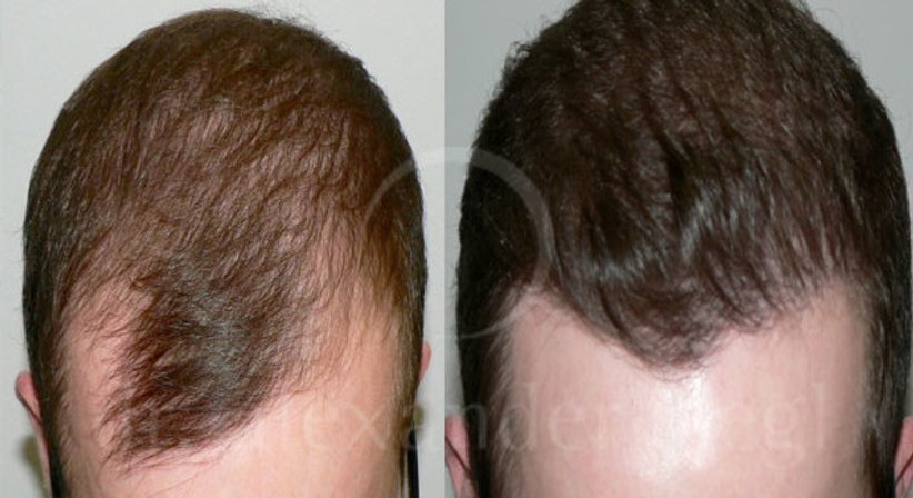 Haartransplantation - Dr. Alexander Siegl - Plastischer Chirurg Wien 1090