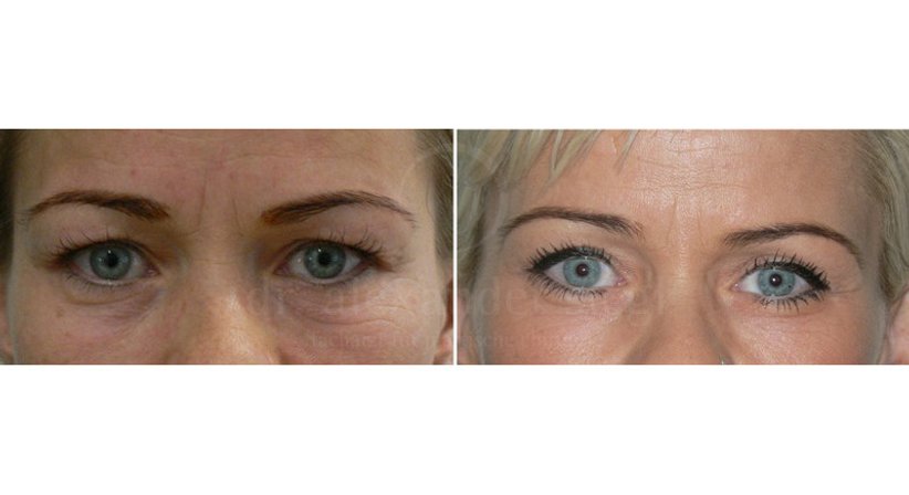 Lidkorrektur - Dr. Alexander Siegl - Plastischer Chirurg Wien 1090