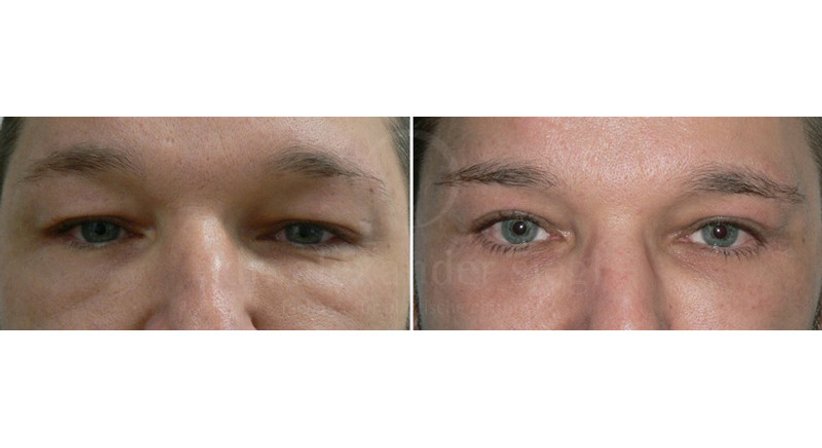 Lidkorrektur - Dr. Alexander Siegl - Plastischer Chirurg Wien 1090