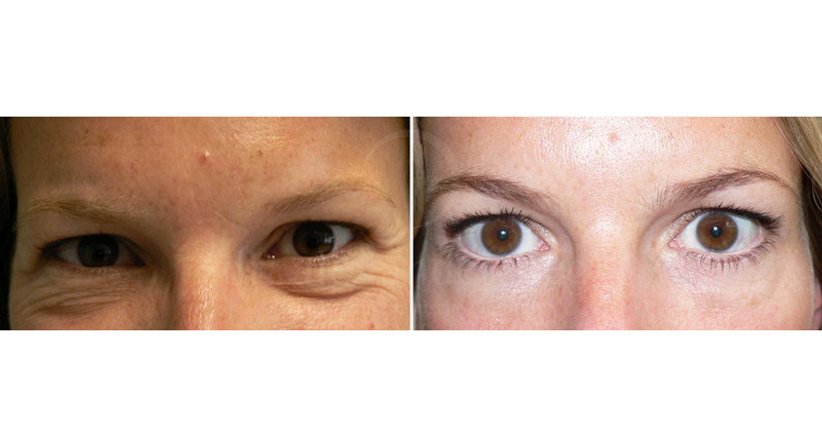 Lidkorrektur - Dr. Alexander Siegl - Plastischer Chirurg Wien 1090