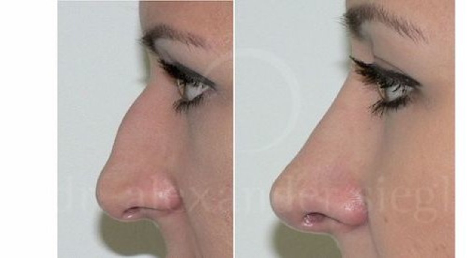 Dr. Alexander Siegl - Nasenkorrektur | Plastischer Chirurg in 1090 Wien ...