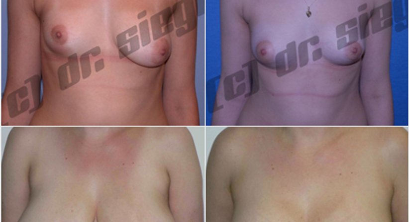 Bruststraffung / Brustverkleinerung - Dr. Alexander Siegl - Plastischer Chirurg Linz 4020