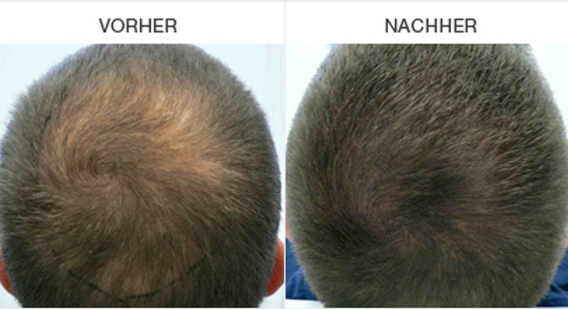 Mikropigmentation - Dr. Alexander Siegl - Plastischer Chirurg Linz 4020