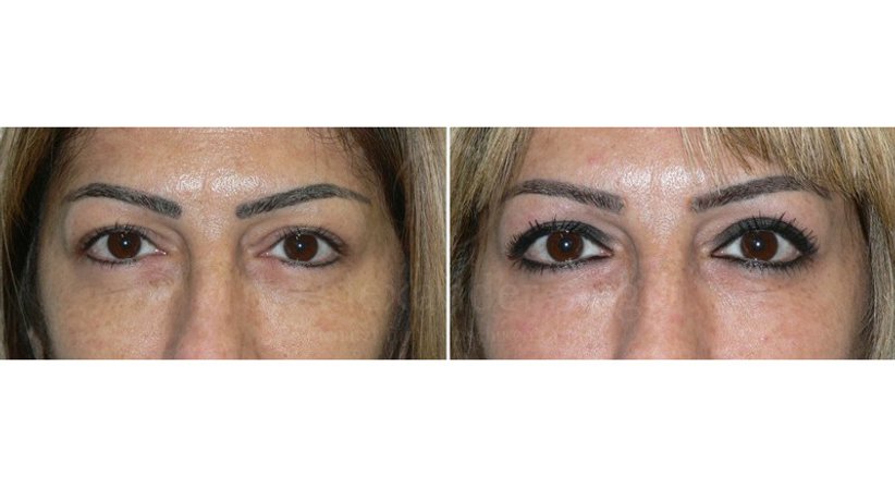 Lidkorrektur - Dr. Alexander Siegl - Plastischer Chirurg Linz 4020