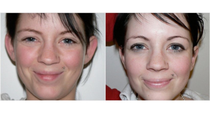 Ohrenkorrektur - Dr. Alexander Siegl - Plastischer Chirurg Linz 4020