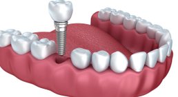 Implantologie -