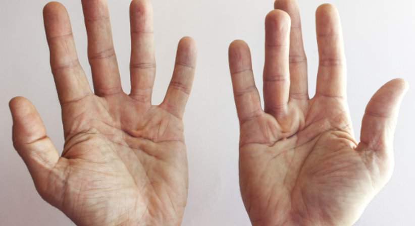 Morbus Dupuytren - OA Priv.-Doz. Dr. Sebastian Farr - Orthopäde Wien 1010