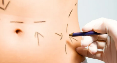 Fettabsaugung (inkl. Lipödem-Behandlung)