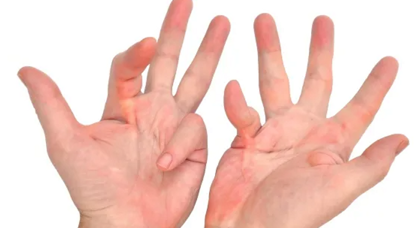 Karpaltunnelsyndrom / Handchirurgie - Priv.-Doz. Dr. Johannes Matiasek - Plastischer Chirurg Schladming 8970