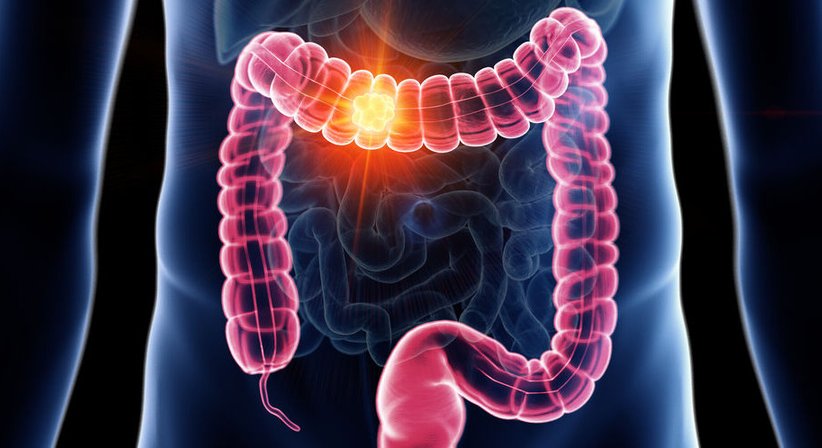 Kolorektales Karzinom - OA. Dr. Zacaria Sow - Allgemeinchirurg/Viszeralchirurg Wien 1210